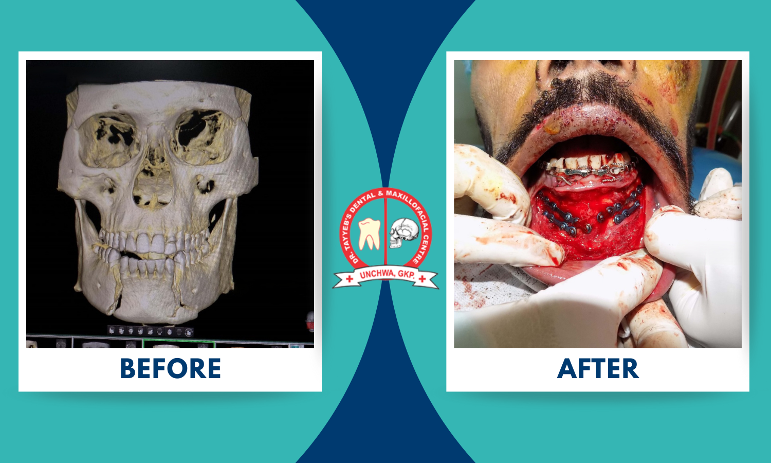 Jaw Fracture Dr Tayyeb